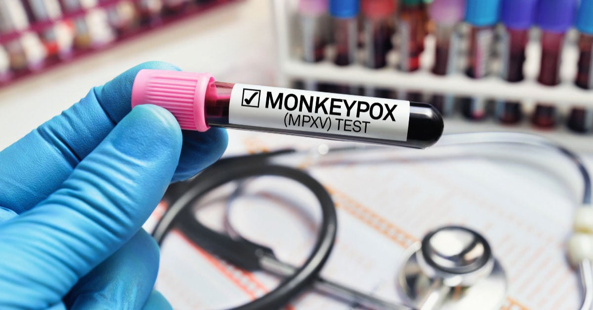 Researcher holding blood test tube infected with monkey pox virus MPXV. Doctor with a blood sample in a tube diagnosed with Monkeypox MPXV disease